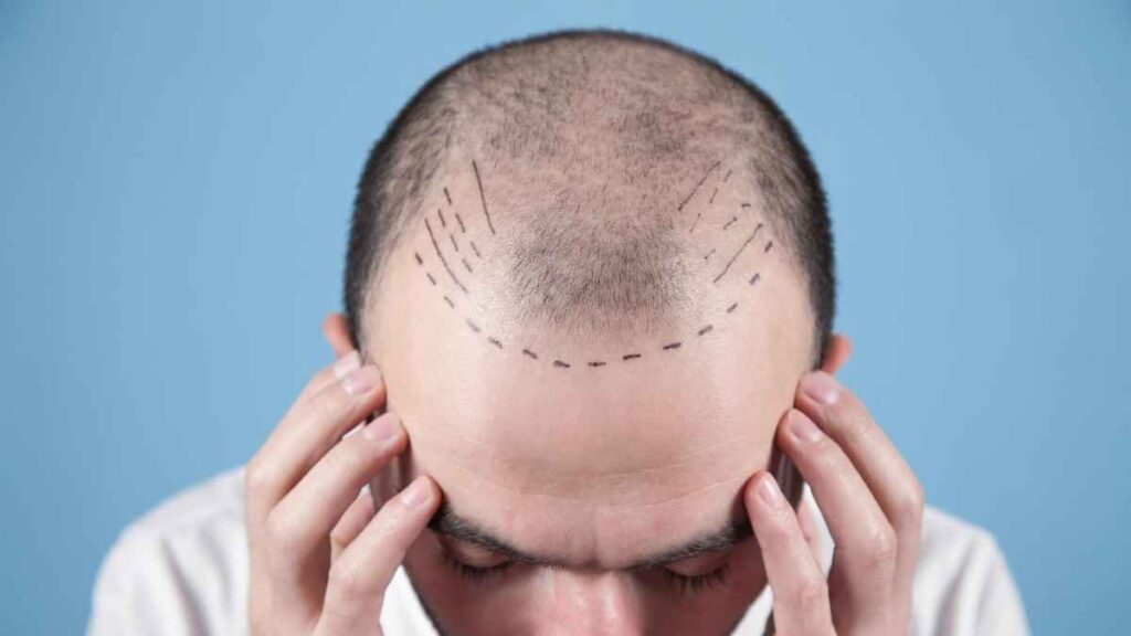 Answers To The Most Frequently Asked 10 Hair Transplant Questions