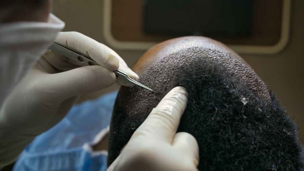 Hair Transplantation in Turkey for African-Americans