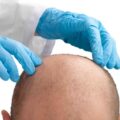 after hair transplantation