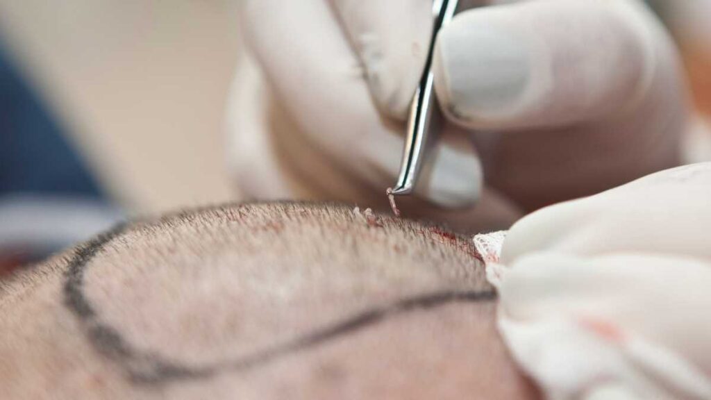 How long does a hair transplant last?